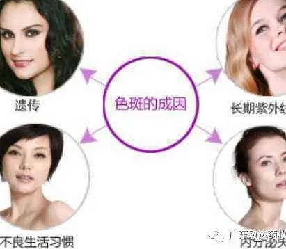 我们脸上为什么会长斑呢？激光祛斑到底靠不靠谱？